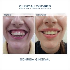 Clínica Londres - Sonrisa Gingival