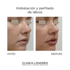 Hidratación y perfilado de labios