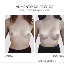 Aumento de pecho - Clínica Londres