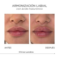 Aumento labios - Clínica Londres